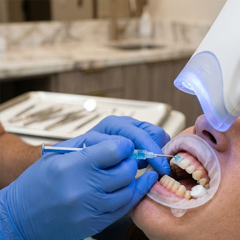 How Is Professional Teeth Whitening Performed?